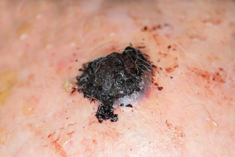 elakartarde-hudforandringar-hudcancer-malignt-melanom