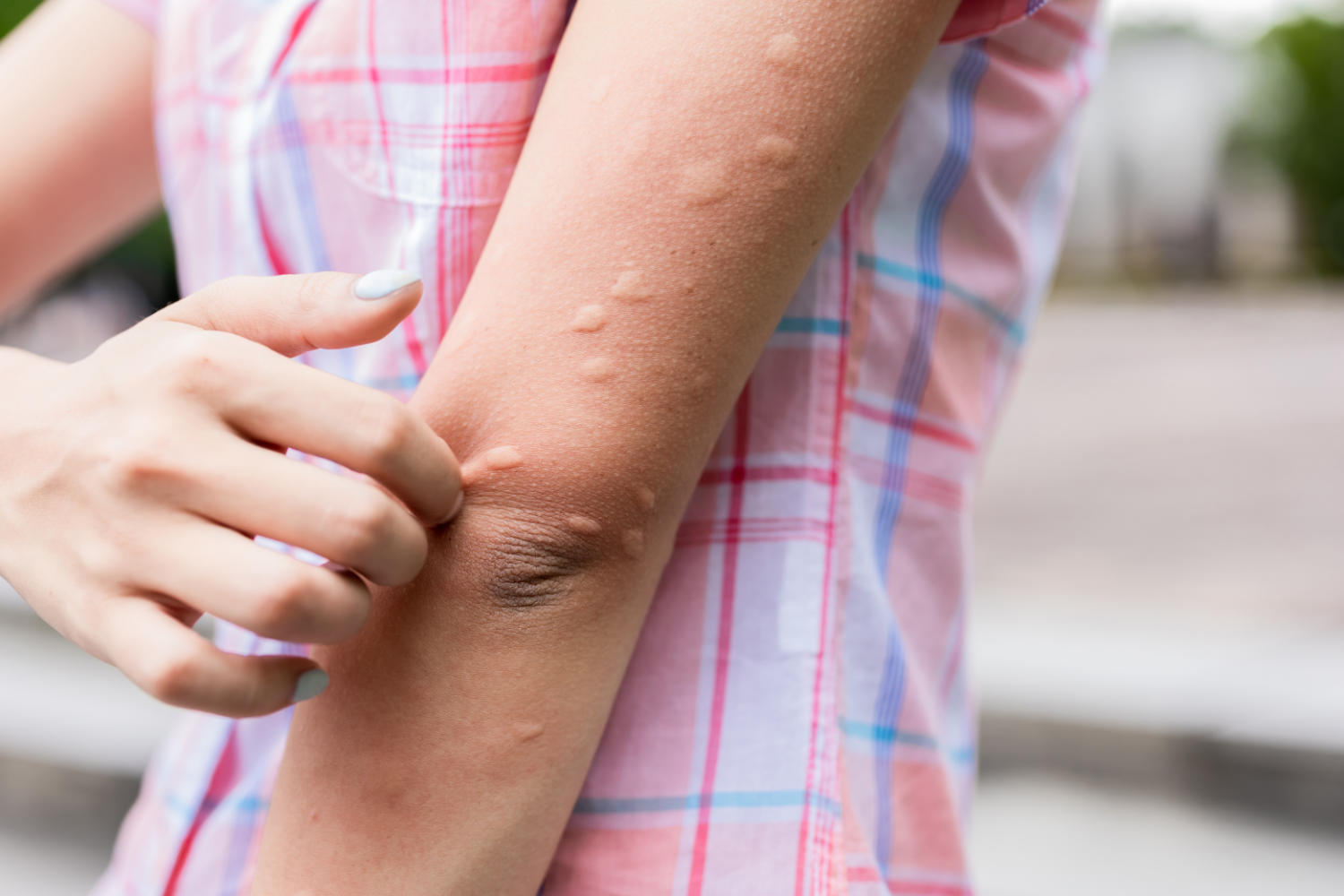 Kvinna med myggbett på armen