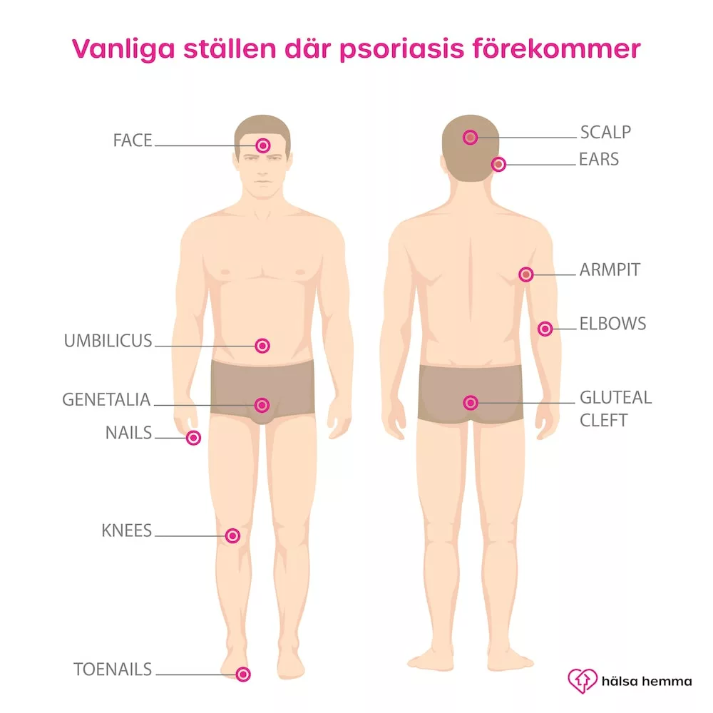 psoriasis-omraden-utslag